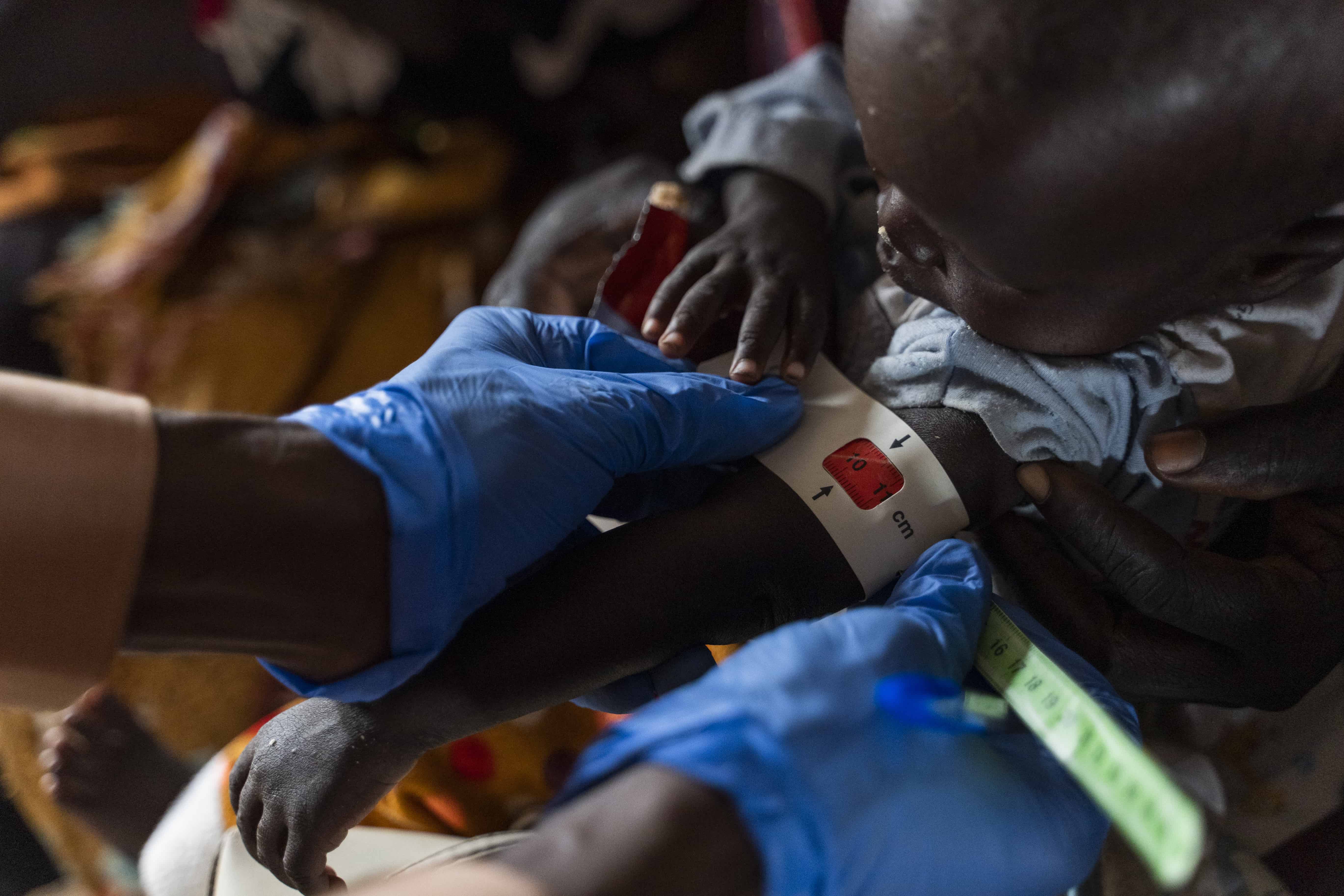 Sudan Malnutrition Rising Among Children Refugee Camp Sudan