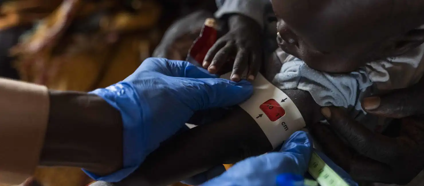 Sudan Malnutrition Rising Among Children Refugee Camp Sudan
